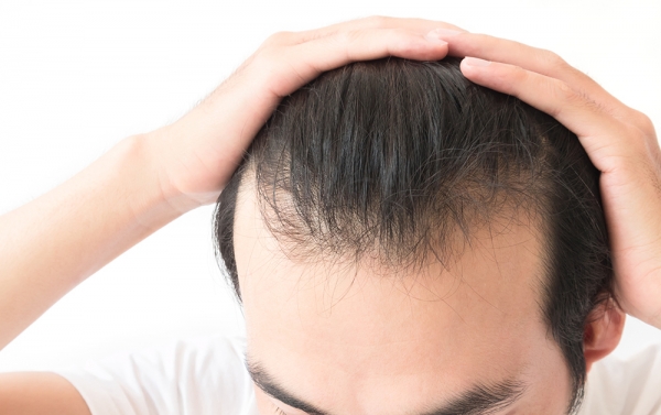 Topp Care Hair Solutions for Hair Loss Prevention